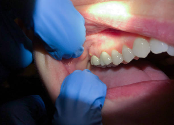 Best Emergency Wisdom Tooth Extraction in Thruston, KY